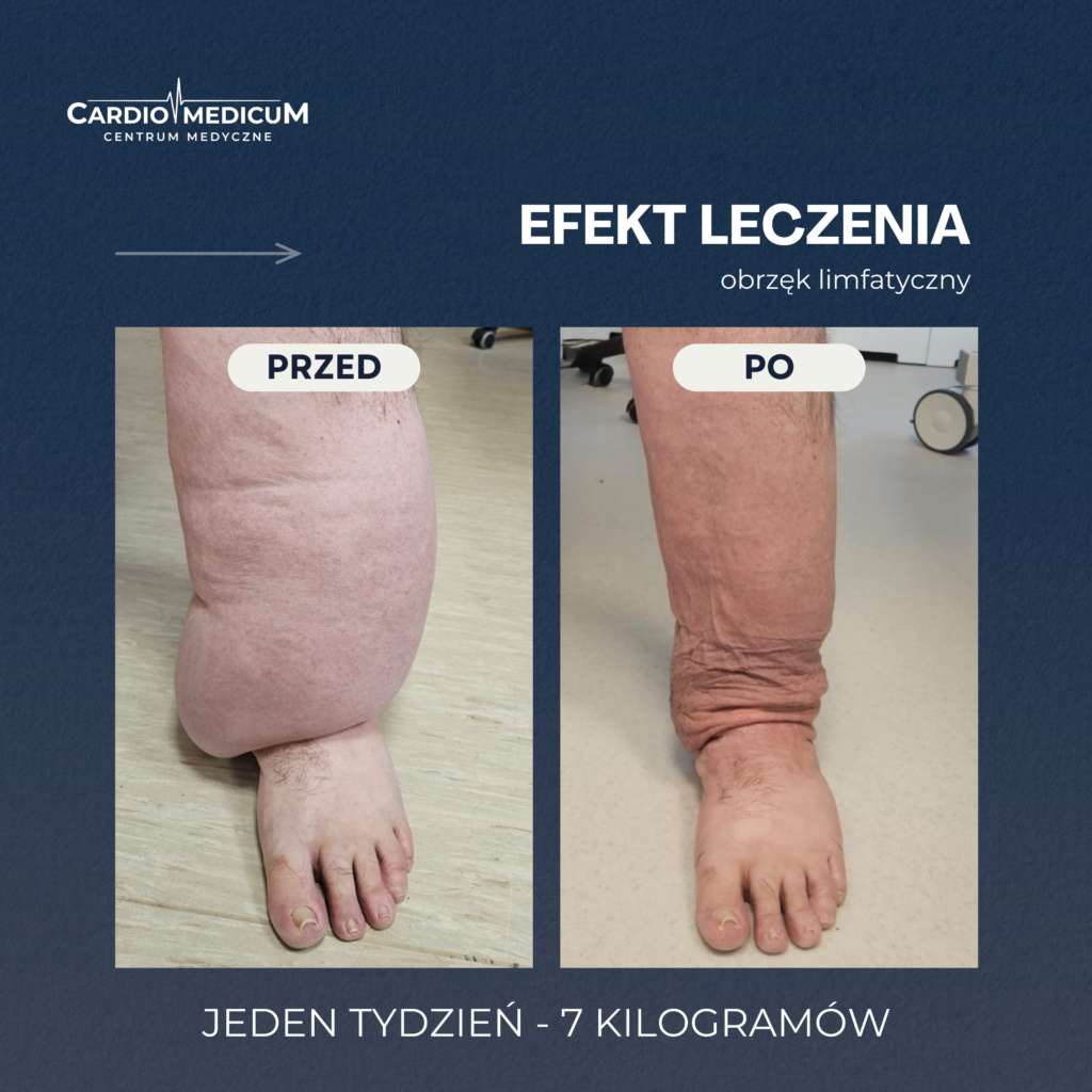 Lipedema